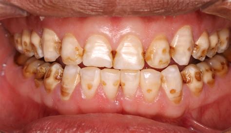 ¿qué Es La Fluorosis ¿tiene Cura ¿cómo La Trata El Dentista
