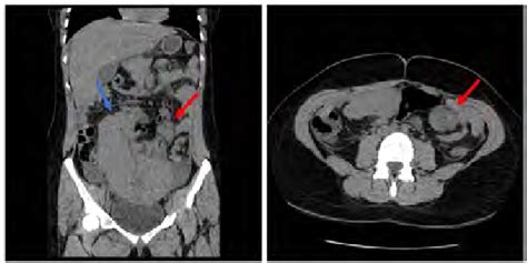 Multislice Ct Scan Images Of Abdomen A Coronal Image Shows That The