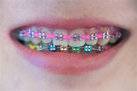 Braces Colors For Teeth