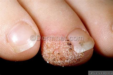 Wart Under Fingernail Photos Nail Ftempo
