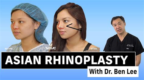 Asian Rhinoplasty In Los Angeles Wave Plastic Surgery Lupon Gov Ph