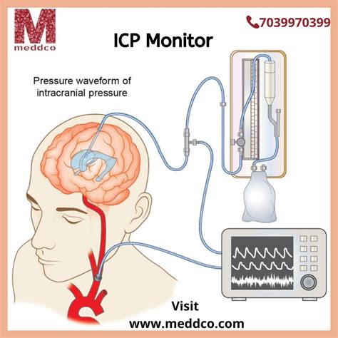 Placement Of Icp Monitor An Overview