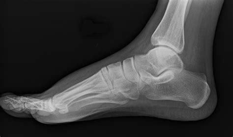 Lateral Foot Radiograph Defender Of Evidence Based Medicine