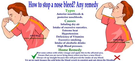Nose Bleedepistaxis How To Manage