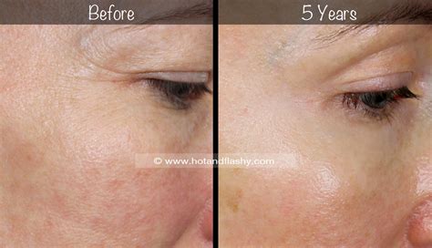 5 Year Retin A Results Before And After For Wrinkles And Anti Aging