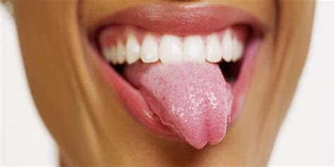 ¿tienes Candidiasis Oral Síntomas Y Tratamiento