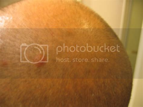 Nasty Red Bumps On My Scalp At Ask Dr Sutter With Image Embedded