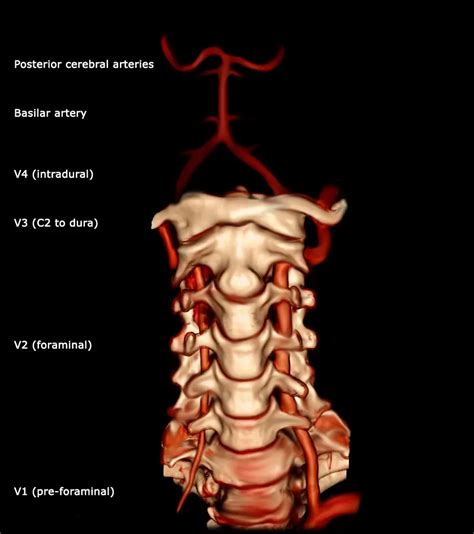 Vertebral Artery And Vertigo What Link Explanation