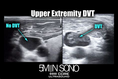 Dvt Core Ultrasound