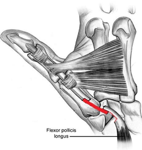 The second patient presented with a flexor pollicis longus (fpl) tendon that was tethered with sutures, in which surgical release of the entrapped fpl tendon led to successful treatment. Figure 1 from Flexor pollicis longus reconstruction using ...