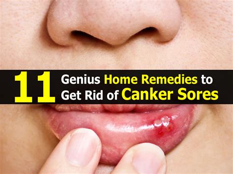 11 Genius Home Remedies To Get Rid Of Canker Sores