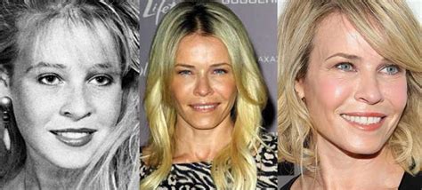 Chelsea Handler Plastic Surgery Before And After Pictures