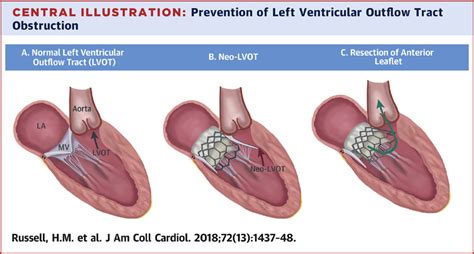 Open Atrial Transcatheter Mitral Valve Replacement In Patients With