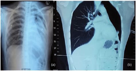 A Chest X Ray Showing Left Lung Collapse Fallen Lung Sign Of Kumpe