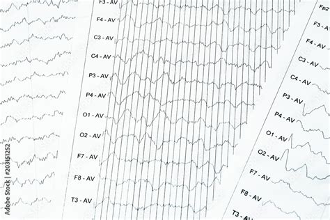 Eeg Electrophysiological Monitoring Method Eeg Wave In Human Brain