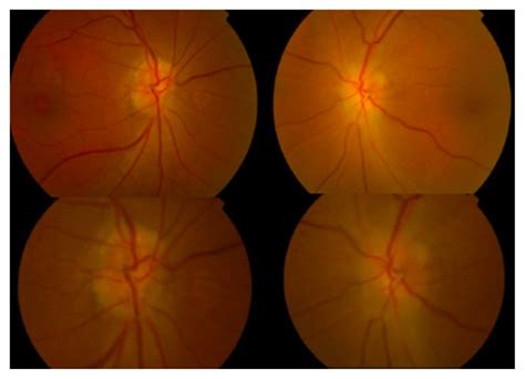 Fundus Photograph Showing Swollen And Hyperemic Left Optic Disc With
