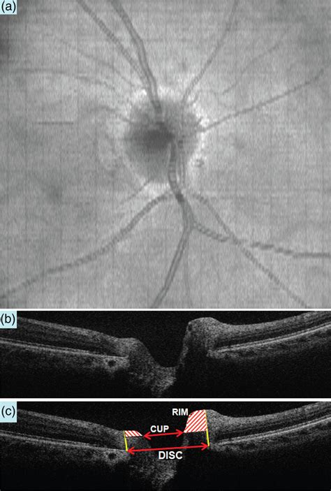 A Horizontal B Scan Oct Image Crossing The Center Of The Optic Nerve