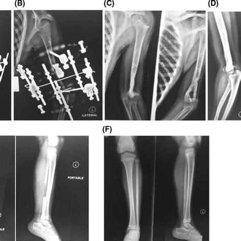 Six Year Old Male With Bone Defect At Left Ulna A B 9 Cm Bone Loss