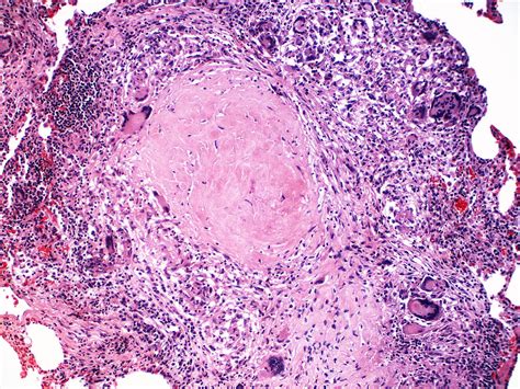 Sarcoidosis With Central Fibrosis Of Granulomas Case 218 Flickr