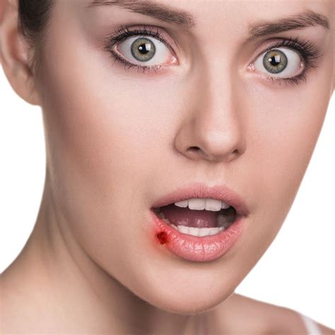 What Can You Do About Canker And Cold Sores