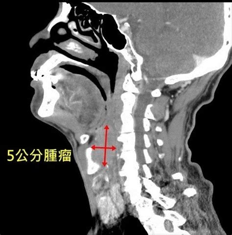 Jun 15, 2021 · 記者潘靚緯／台中報導. 醫病》脖子長腫塊不以為意 竟是下咽癌3期 - 生活 - 自由時報電子報