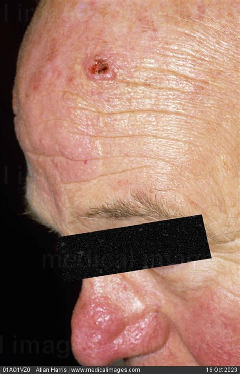 Stock Image 01aq1vz0 Cancer Basal Cell Carcinoma Rounded Lesion With