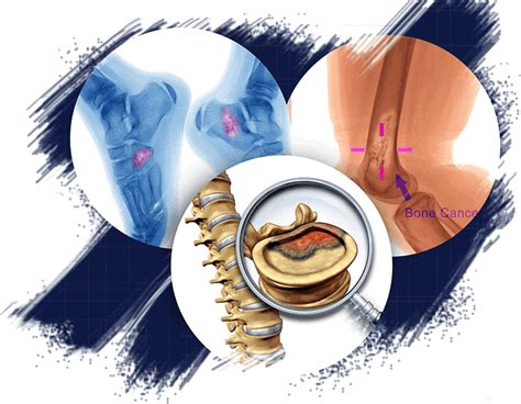 Osteosarcoma is also the most common bone tumor in cats, but the behavior of this tumor type is less aggressive than in dogs. Bone Cancer Treatment - Procedure, Consultation, Cost