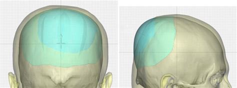 Plastic Surgery Case Study The Over Corrected Custom Occipital Skull