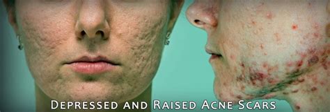 Depressed And Raised Acne Scars Medscar