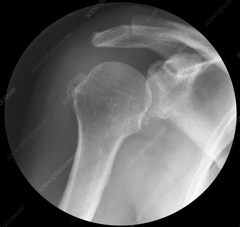 Arthritis Of The Shoulder X Ray Stock Image C0030894 Science