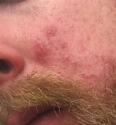 Skin Concern Persisting Irritated Skinbumps On Cheek For A Month