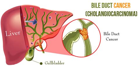 Cholangiocarcinoma Bile Duct Cancer Causes Symptoms Treatment