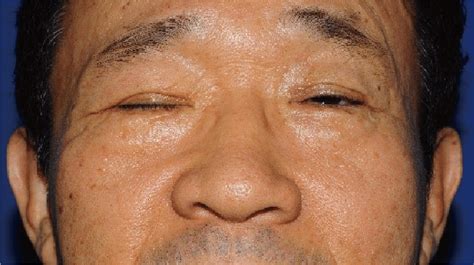 The Patient Had Bilateral Blepharoptosis Of The Upper Eyelids And The