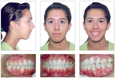 We did not find results for: Nonsurgical treatment for a severe anterior and lateral ...