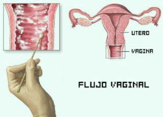Flujo Vaginal Ecured