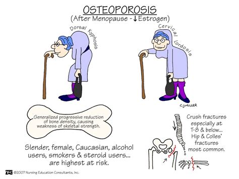 Osteoporosis Nursing Mnemonics Surgical Nursing Medical Surgical