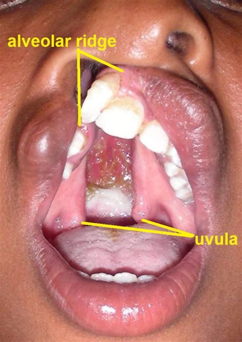 Classifications Of Cleft Palate Facial Anomalies With Images Cleft Lip And Palate Cleft