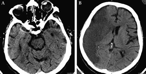Hyperdense Middle Cerebral Artery Sign An Early Radiological Finding