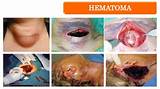 Surgical Hematoma Treatment Photos