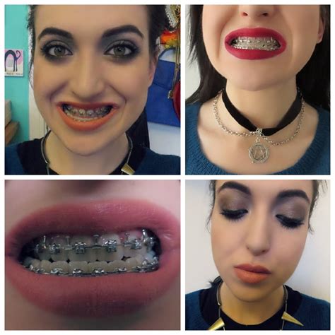 Braces Before And After Underbite Braces Before And After Reverasite