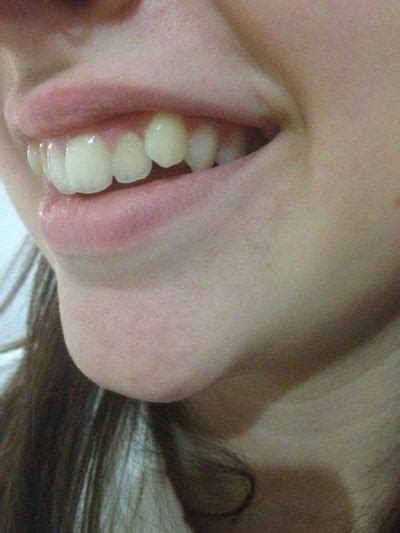 Sometimes extractions are better for your profile instead of worse and it looks like in your case, it would help your profile to have teeth removed and get all your teeth properly angulated. Looking to "fix" protruding canine teeth. Are veneers or ...
