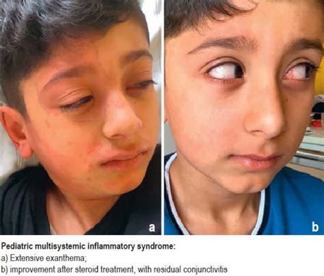 Pediatric Multisystemic Inflammatory Syndrome Associated With Sars Cov