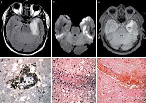The temporal lobes have unique architecture, and functionality that makes them vulnerable to certain disease processes. Magnetic resonance imaging and microscopic images of ...