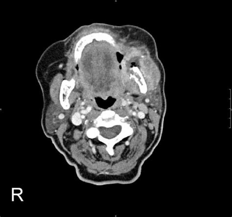 Computerized Tomography Ct With Contrast Medium Cm Axial Image Of