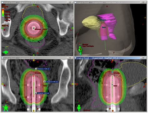 Cureus Stereotactic Body Radiosurgery Using Volumetric Arc Therapy As An Alternative To High