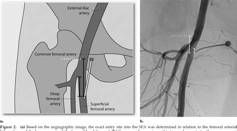 Medisonru Superficial Femoral Artery Common Femoral