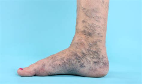 Do You Suffer With Varicose Veins In These Intimate Places Health