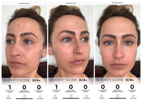 La Roche-Posay Launches Effaclar Adapalene Gel 0.1% Acne Treatment | Allure