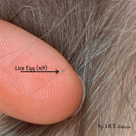 World Biggest Head Lice