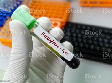Blood Sample For Haptoglobin Test Diagnosis Of Hemolytic Anemia Stock